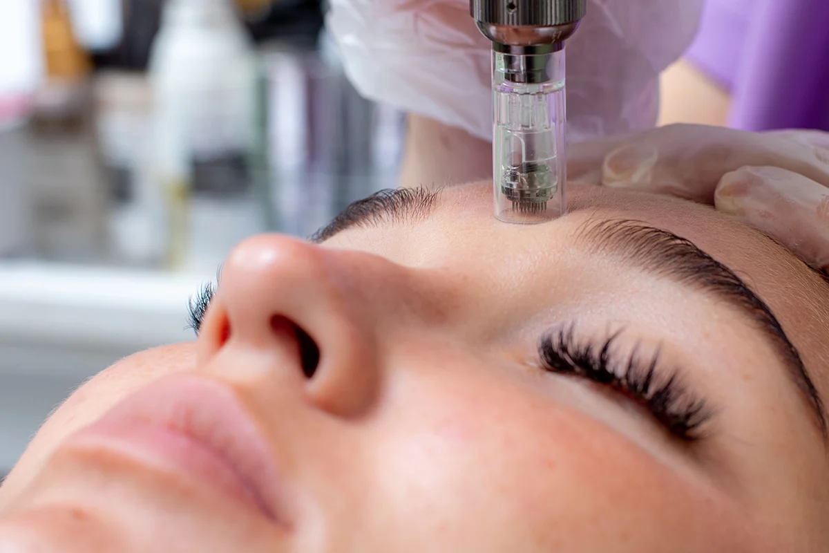 Microneedling Microdermabrasion Winnipeg