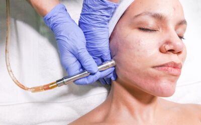 How Long Do Microdermabrasion Results Last?