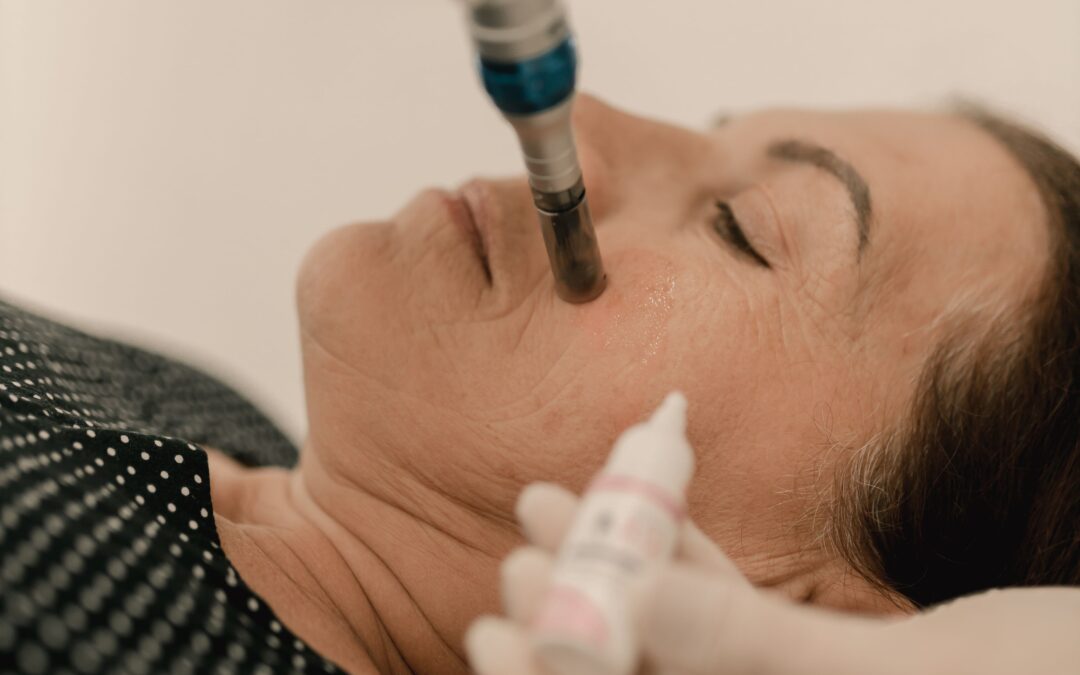 Microdermabrasion in Winnipeg: Benefits, Cost, and What to Expect